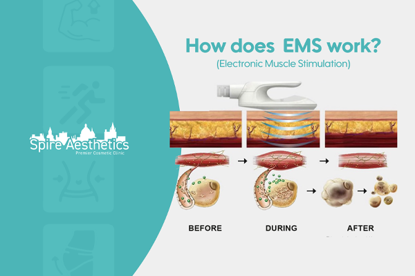 EMS treatment for post pregnancy weight loss treatment Newark on Trent