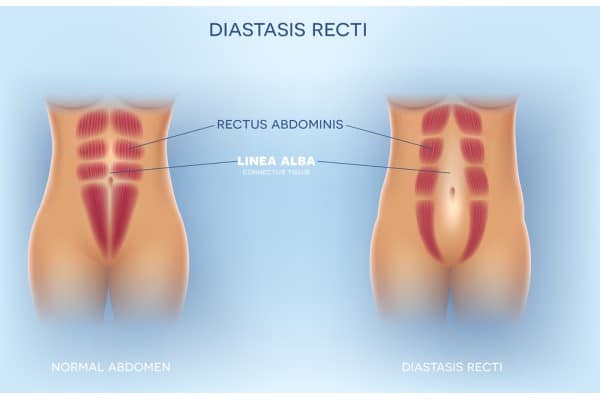 What Non-Surgical Options Are Available for Diastasis Recti Newark on Trent?
