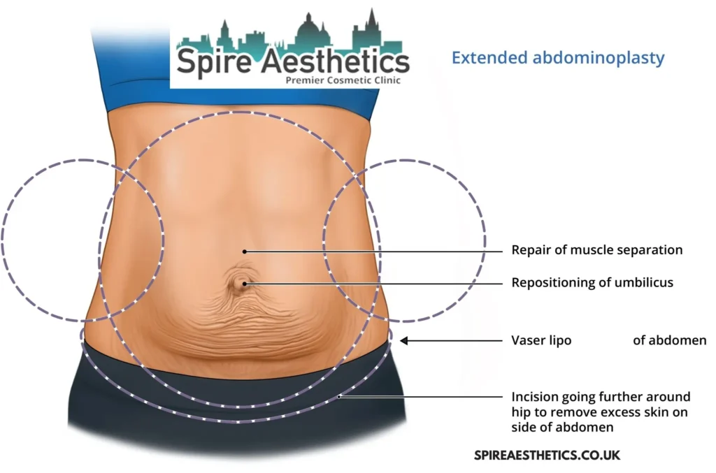 Understanding Loose Skin After Gastric Band Newark on Trent Surgery and HIFU Treatment