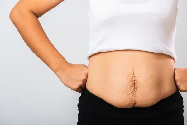 Image of a woman's stomach after weight loss with sagging skin following a gastric band Newark on Trent