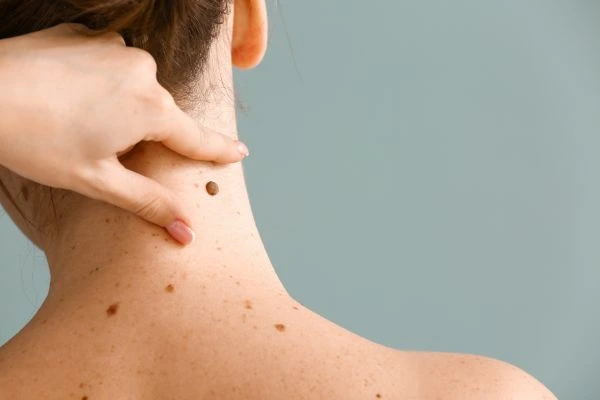 Prices and promotions for blemish removal Newark on Trent contact our team today!