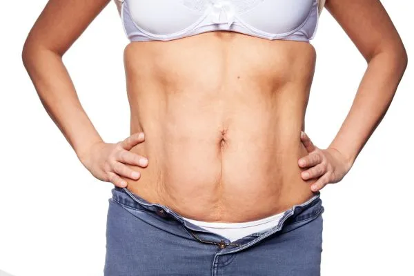 sagging skin on woman's stomach after weight loss injections Newark on Trent