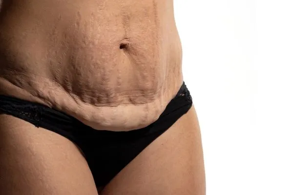 Image of womans stomach after weight loss injections Newark on Trent showing saggy skin