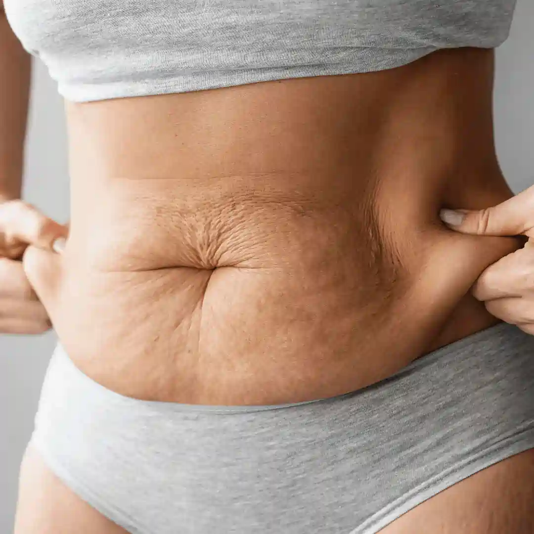 Is It Normal to Have Loose Skin After Pregnancy Newark on Trent?
