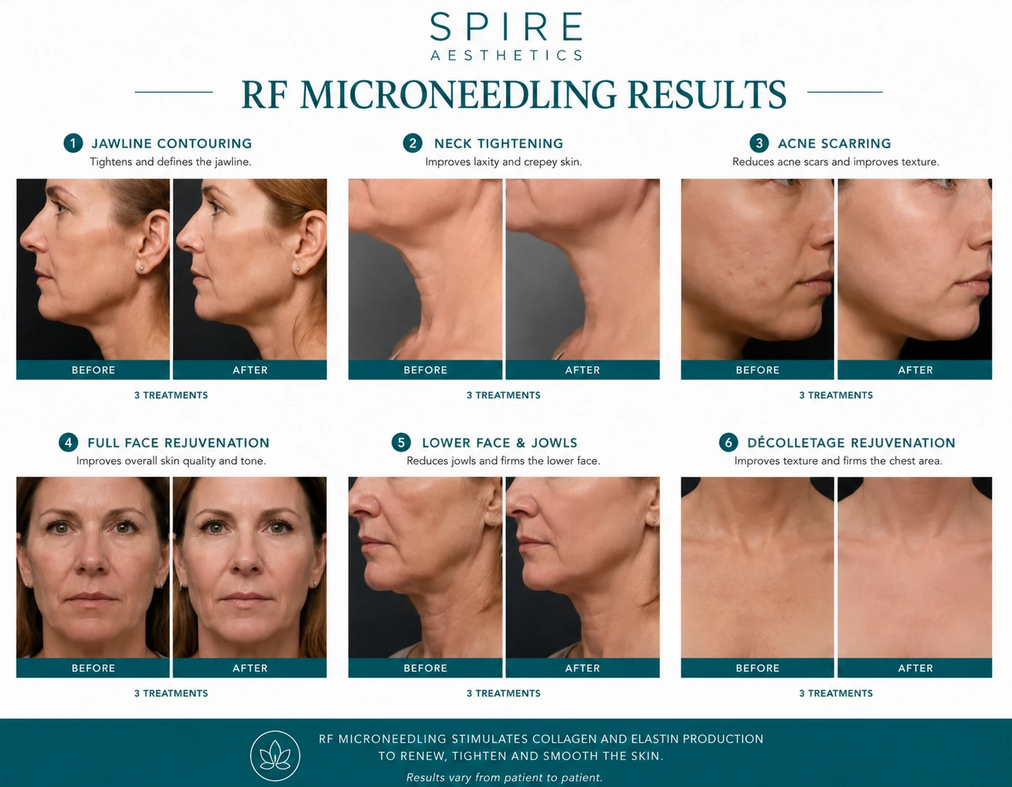 RF Microneedling Skin tightening Newark on Trent results
