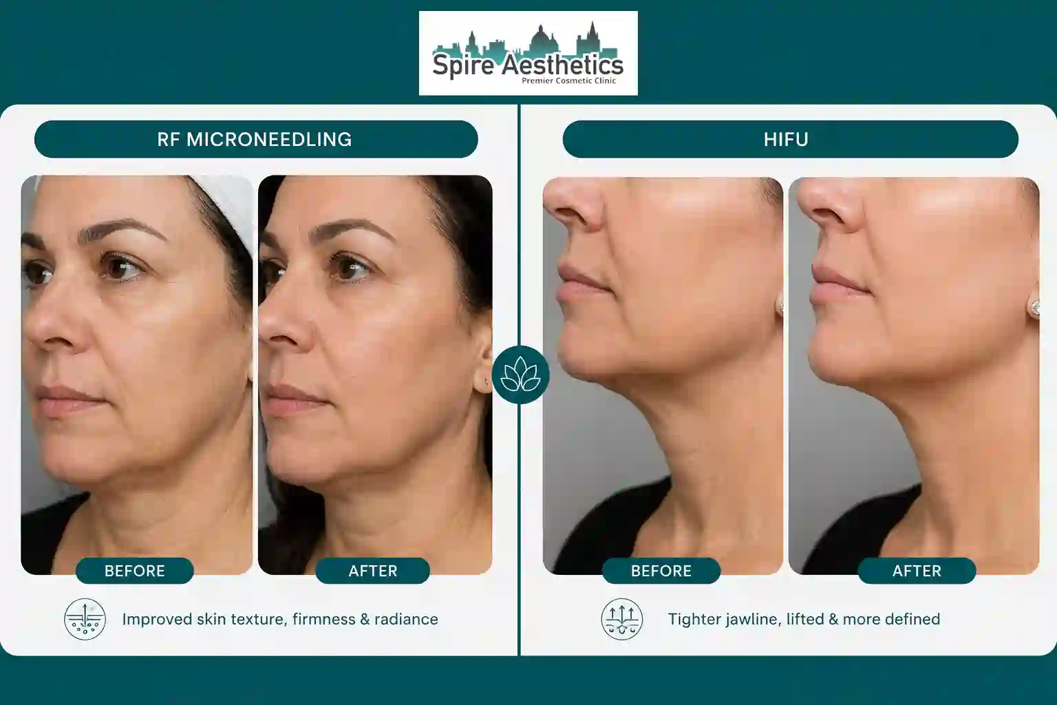 Can RF Microneedling and HIFU Be Combined Newark on Trent?