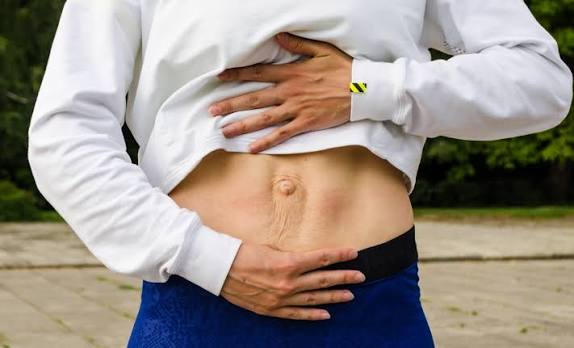 When Could Diastasis Recti Be the Missing Piece of the Puzzle Newark on Trent?