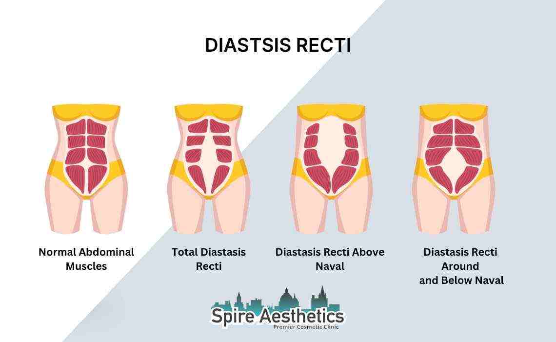Is Non-Surgical Diastasis Recti Treatment Right for You? Common Concerns Answered Newark on Trent